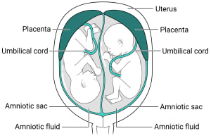 Twins with two placentas and two amniotic sacs. Within the uterus, there are two placentas with their own amniotic sac, amniotic fluid, and fetus inside.