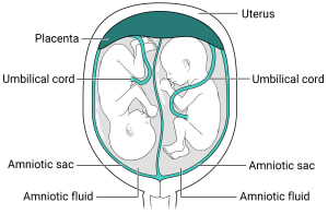 Twins with one placenta and two amniotic sacs. Within the uterus, there is one placenta with two amniotic sacs. Each sac has its own amniotic fluid and fetus inside.