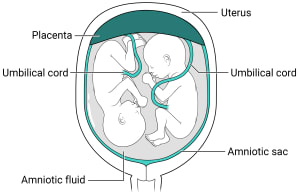 Twins with one placenta and one amniotic sac. Within the uterus, there is one placenta with an amniotic sac, amniotic fluid, and two fetuses inside.
