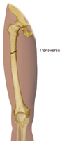 Haga clic en la imagen para ampliarla. Ilustración de una fractura transversa