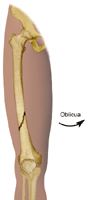 Haga clic en la imagen para ampliarla. Ilustración de una fractura oblicua