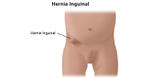 Haga clic en la imagen para ampliarla Ilustración de una hernia inguinal