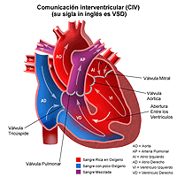 Haga clic en la imagen para ampliarla Anatomía de un corazón con una comunicación interventricular