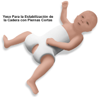 Haga clic en la imagen para ampliarla. Ilustración de un niño con un yeso en espiga pelvipédico corto