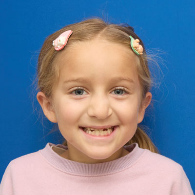 Cleft Lip before and after patient photos