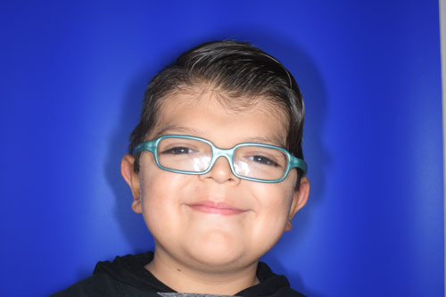 Craniosynostosis before and after patient photos