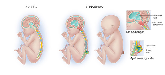 Spina Bifida chart