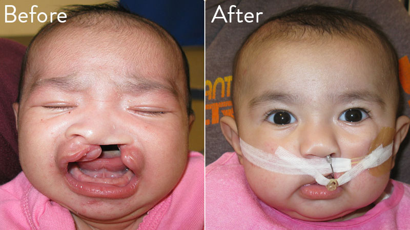 Patient 2 before and after nasoalveolar molding (NAM)