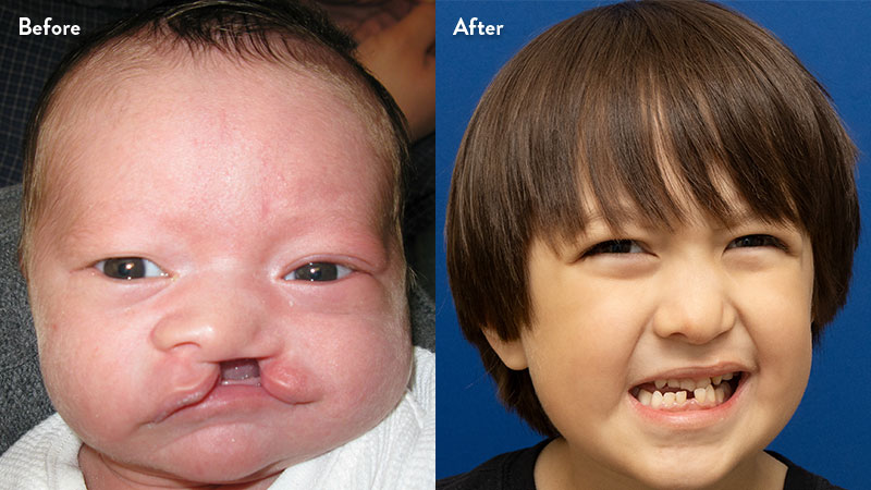 Before and after of boy with cleft lip