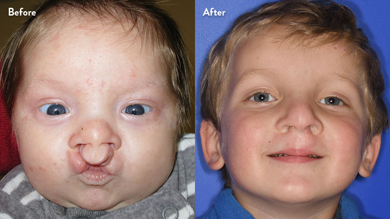 Before and after of boy with cleft lip