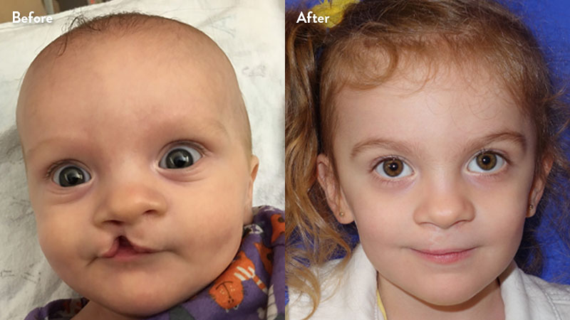 Before and after of girl with cleft lip