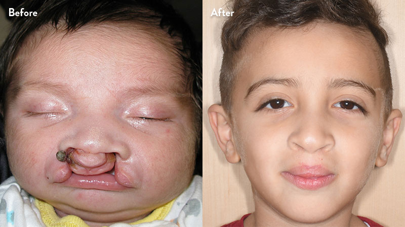 Before and after of boy with cleft lip