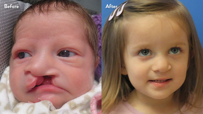 Before and after of girl with cleft lip