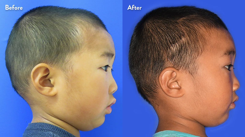 Patient profile of sagittal craniosynostosis