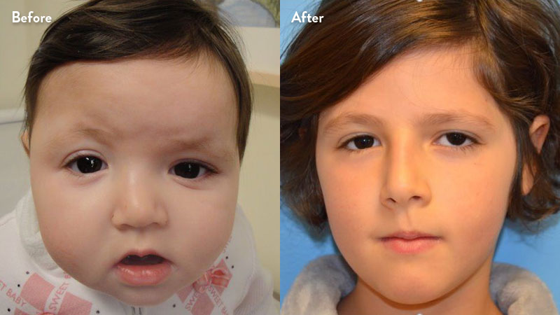 Front image right unicoronal craniosynostosis