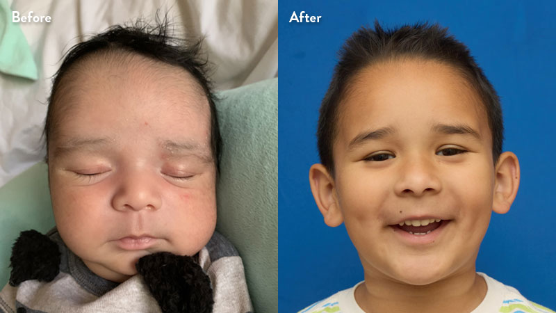 Patient frontal image of sagittal craniosynostosis