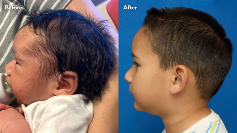 Patient profile of sagittal craniosynostosis