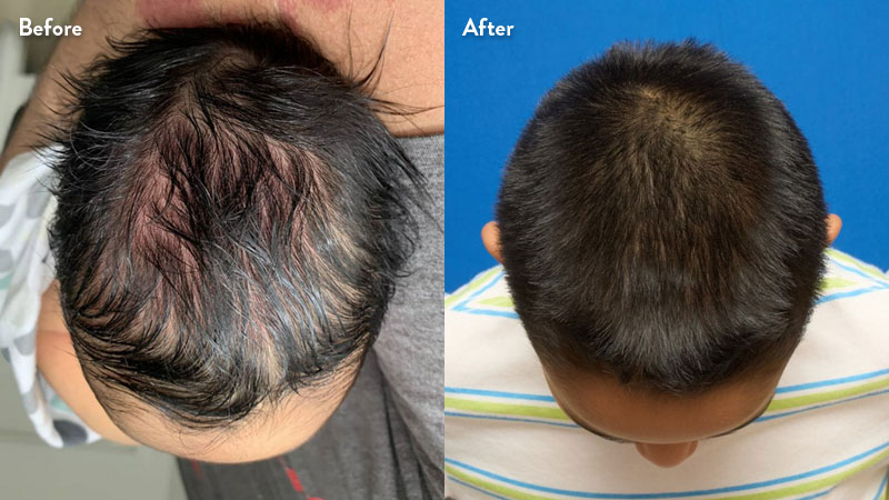 Patient top image of  sagittal craniosynostosis