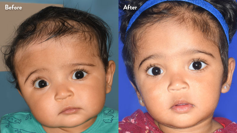 Patient frontal image of right unicoronal craniosynostosis