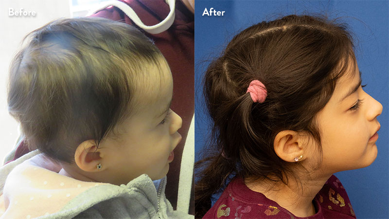 Patient profile of bilateral coronal craniosynostosis