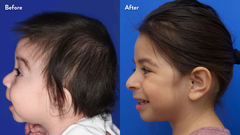 Profile view of metopic craniosynostosis