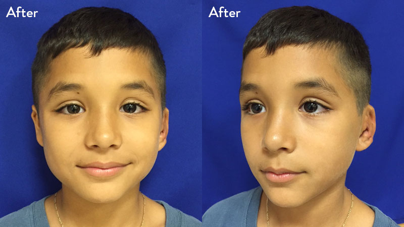 10 year old male with grade 2 microtia 1