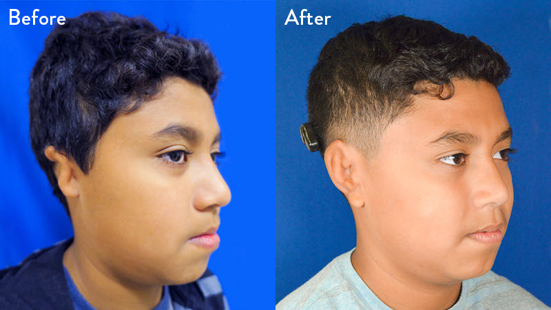 grade 3 microtia before and after close up