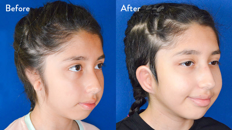 grade 3 microtia before and after