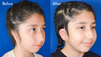 11-year-old female with right grade 3 microtia