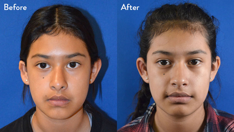 13-year-old Female with Grade 2 Microtia