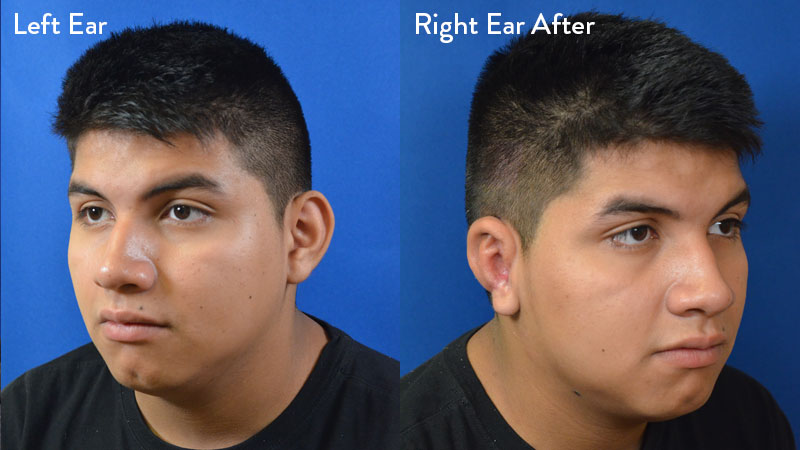 14-year-old-male with Grade 2-3 Microtia