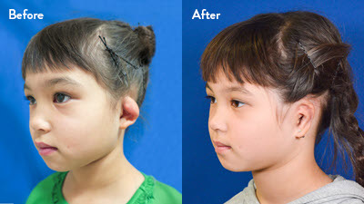 8 year old female with left grade 2 microtia