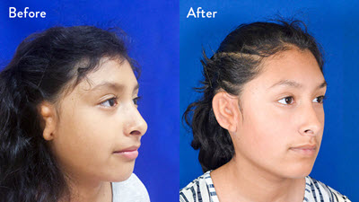 9-year-old female with right grade 2 microtia