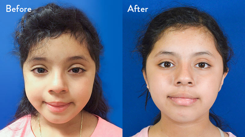 Grade 2 Microtia before and after