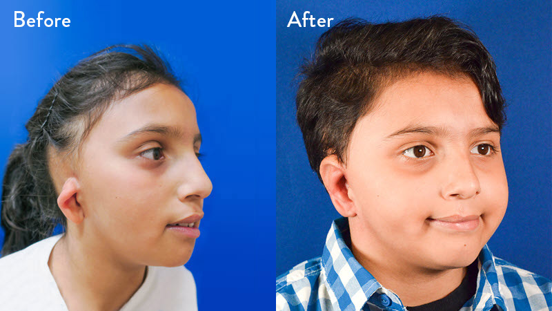 Grade 2 Microtia before and after