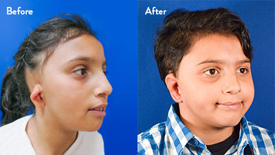 9-year-old Male with Right Grade 2 microtia