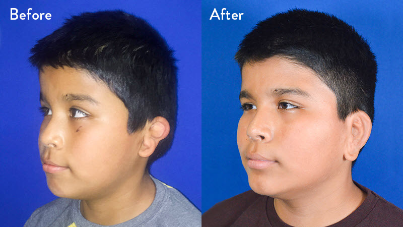 9-year-old Male with Left Grade 2-3 Microtia