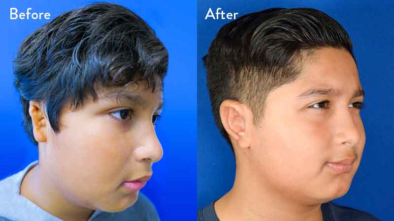 Grade 2 Microtia before and after close up