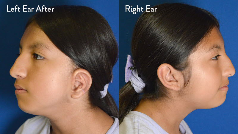 Microtia Grade 2 After