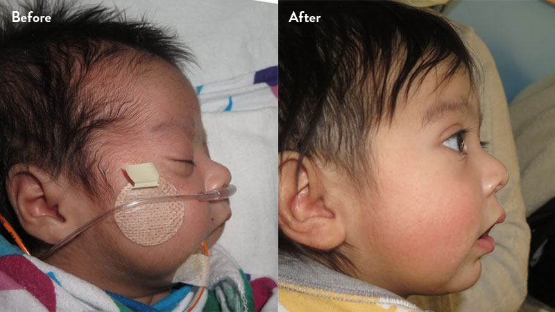 Before and after of infant with orthodontic airway plate treatment