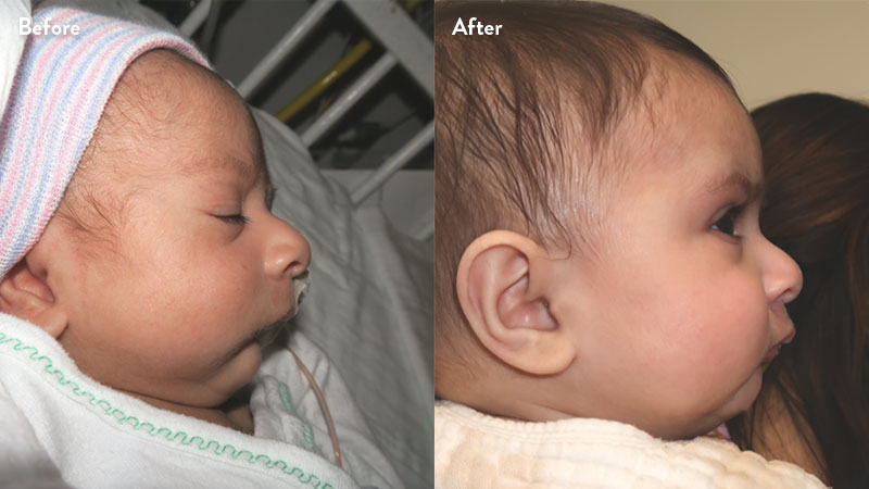 Before and after of infant with orthodontic airway plate treatment