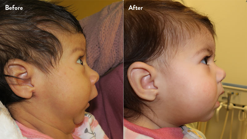 Before and after of infant with orthodontic airway plate treatment