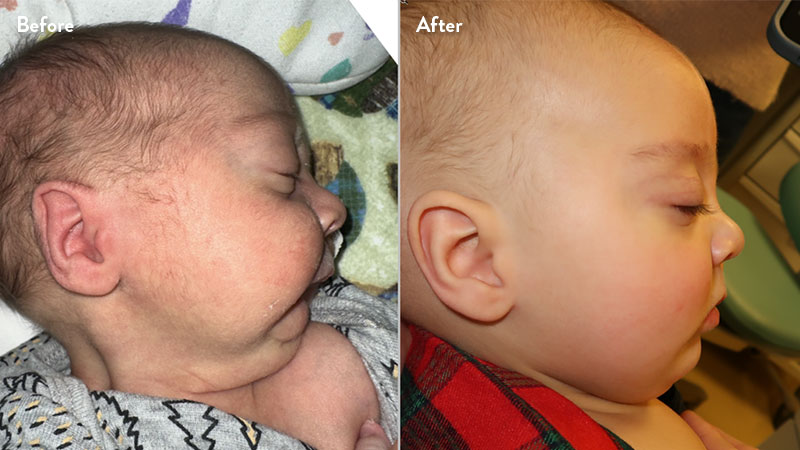 Before and after of infant with orthodontic airway plate treatment