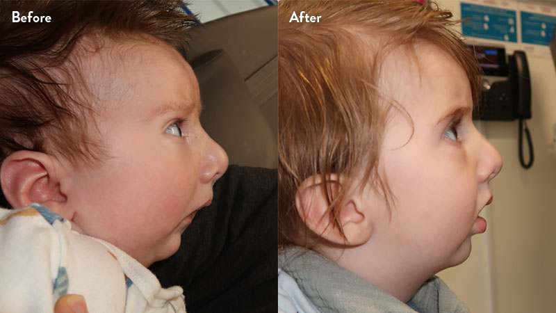 Before and after of infant with orthodontic airway plate treatment