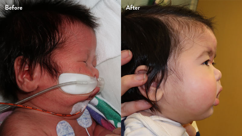 Before and after of infant with orthodontic airway plate treatment