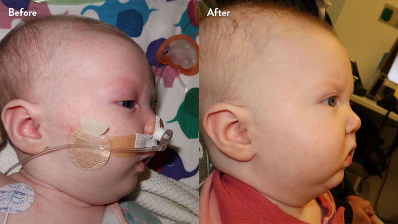 Before and after of infant with orthodontic airway plate treatment