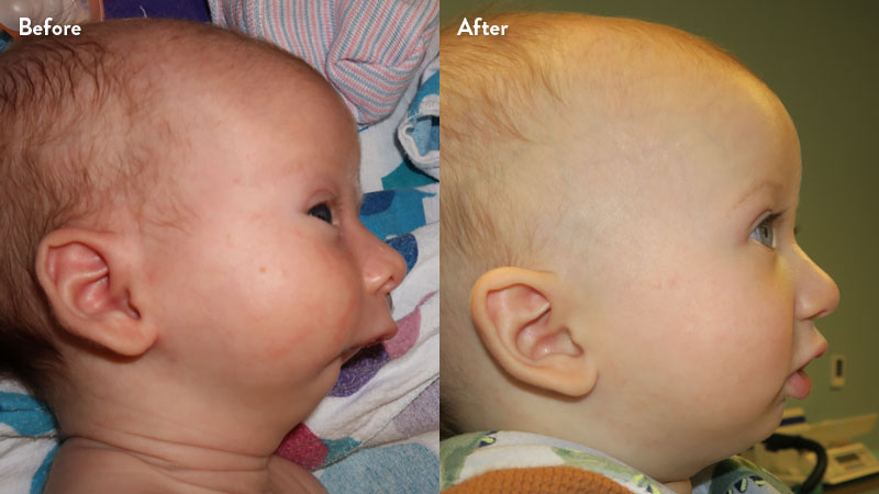 Before and after of infant with orthodontic airway plate treatment