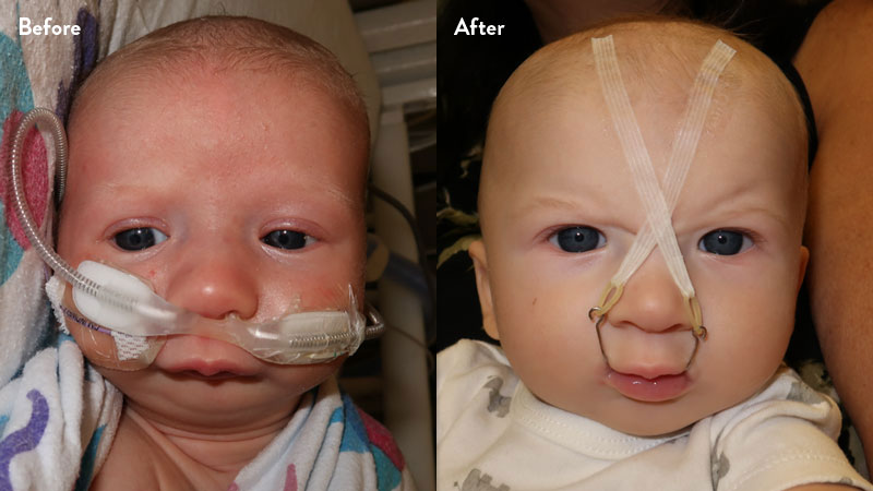 Before and after of infant with orthodontic airway plate treatment