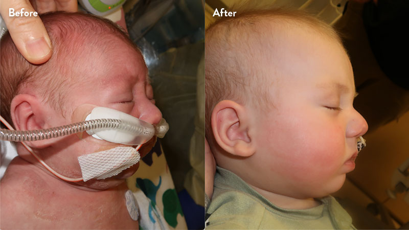 Before and after of infant with orthodontic airway plate treatment