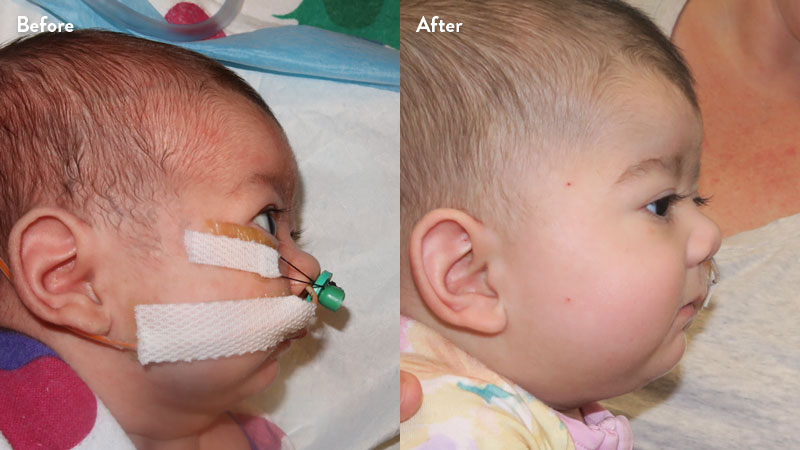 Before and after of infant with orthodontic airway plate treatment